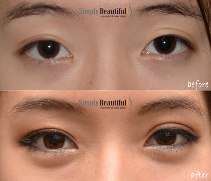 asian double eyelid surgery sydney dr peter kim