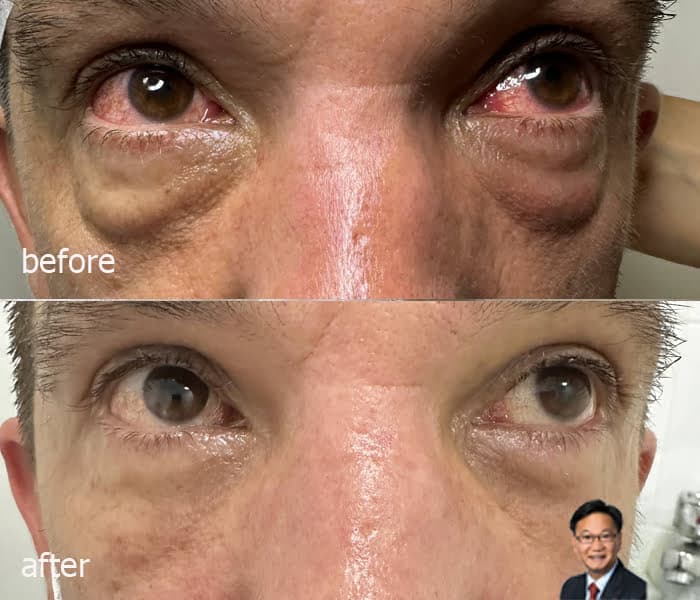 lower eyebag removal blepharoplasty sydney dr peter kim